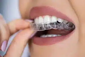 Bruxism Treatment