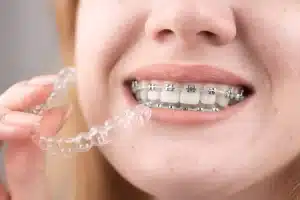 Spark Clear Aligners